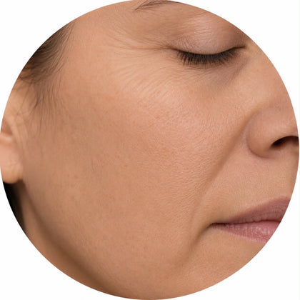 Stimulation du collagene