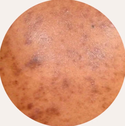 Hyperpigmentation post-inflammatoire