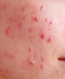Acné inflammatoire